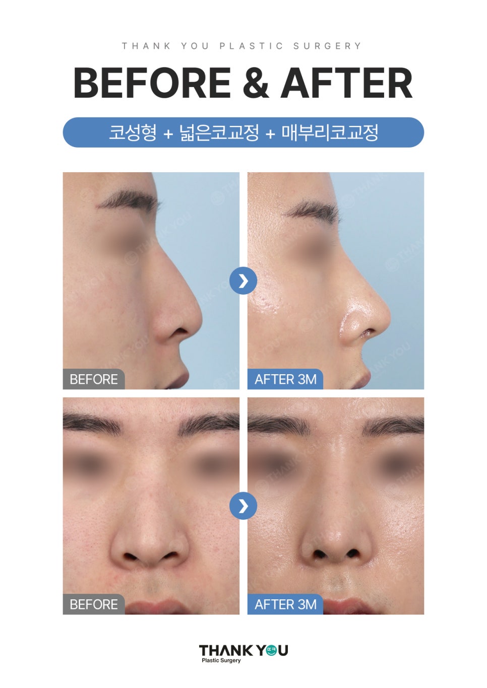 자가늑연골? 기증늑연골? 코성형수술 재료의 끝판왕? 관련 이미지 11