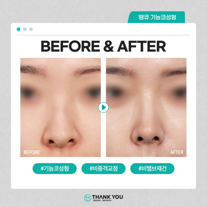 기능코수술병원에서 콧 속 불편함, 외적 스트레스 동시 해소! 관련 이미지 11