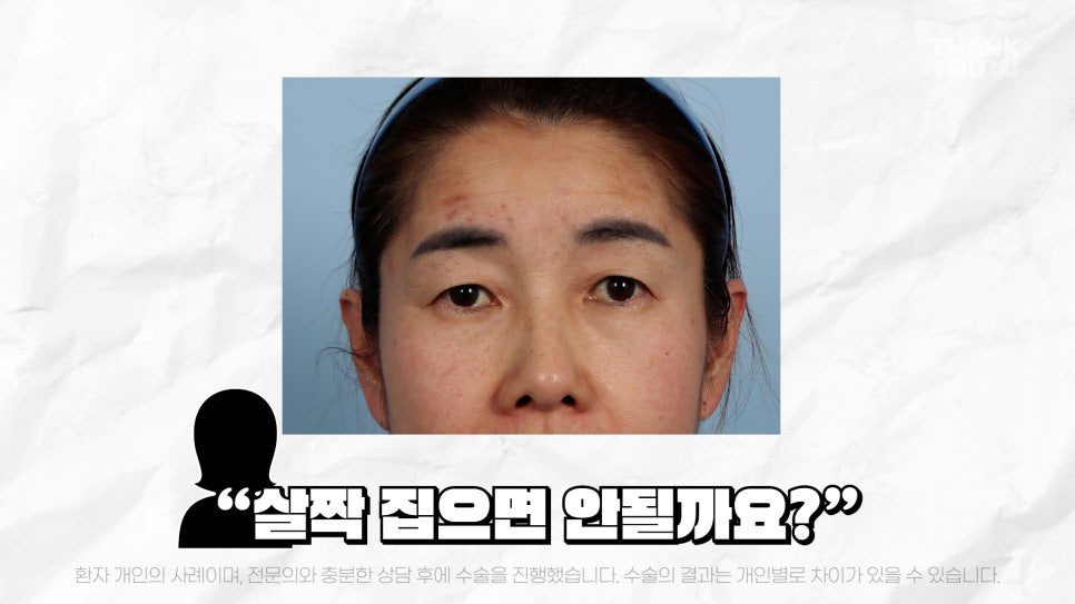 중년눈성형 전후& 이마거상+눈썹하거상+쌍수로 젊어지기 관련 이미지 9
