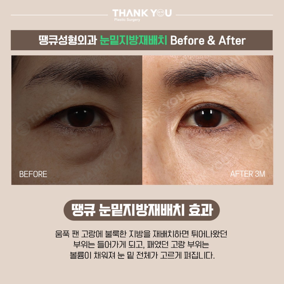 프리미엄 눈밑지방재배치(원데이)란? 땡큐 이호준 원장님 관련 이미지 5