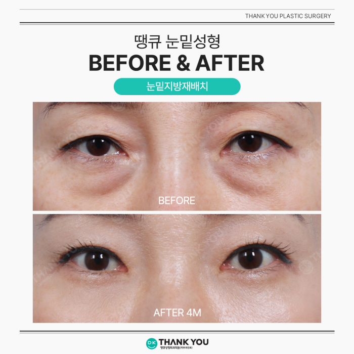 Lower Blepharoplasty and Under-Eye Fat Repositioning: What’s the Difference? image 12