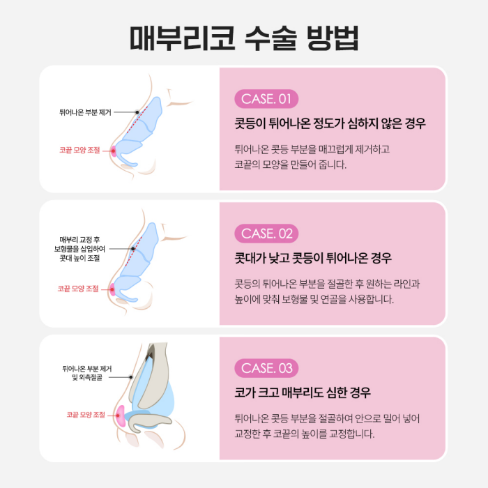 매부리코성형, 개인 맞춤 수술로 만족도 UP! 관련 이미지 6