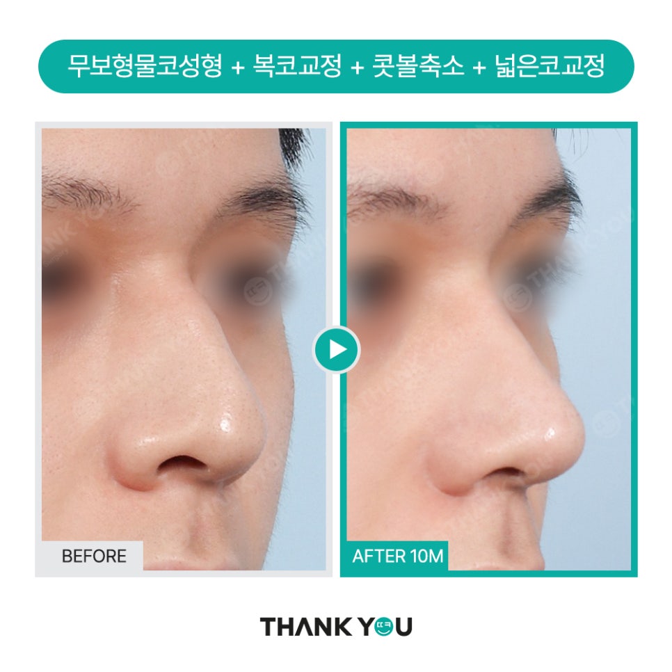 자가늑연골 코수술 장단점, 실리콘없이 무보형물 전후Check 관련 이미지 14