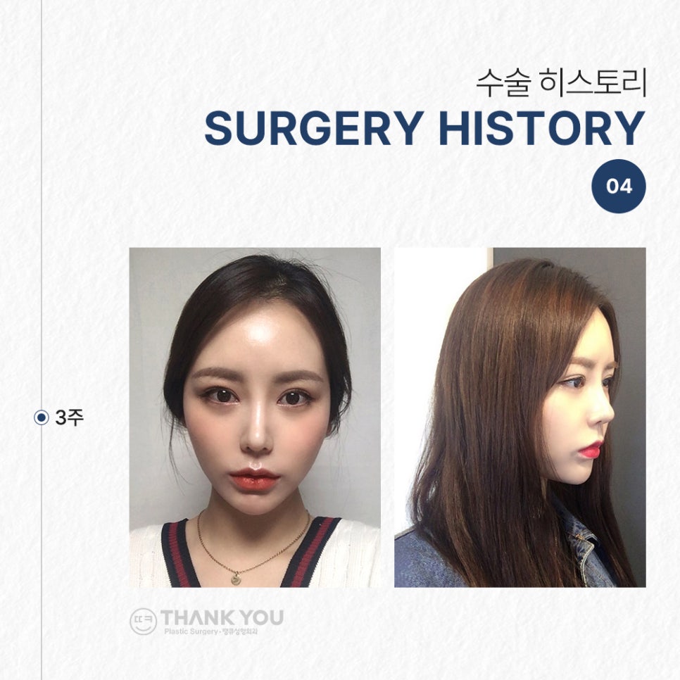 코필러 대신 여자코성형 (콧대+코끝)자연스럽게 관련 이미지 7