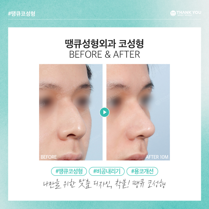비공내리기로 용코교정하고 조화로운 코 만들기🍀 관련 이미지 10