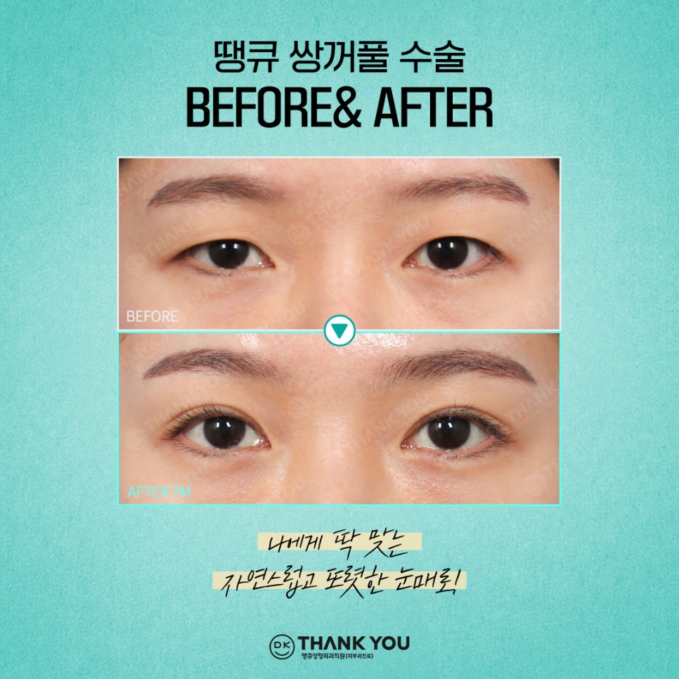첫눈성형 후기 좋은 땡큐에서 만드는 예쁜 눈매💚 관련 이미지 4