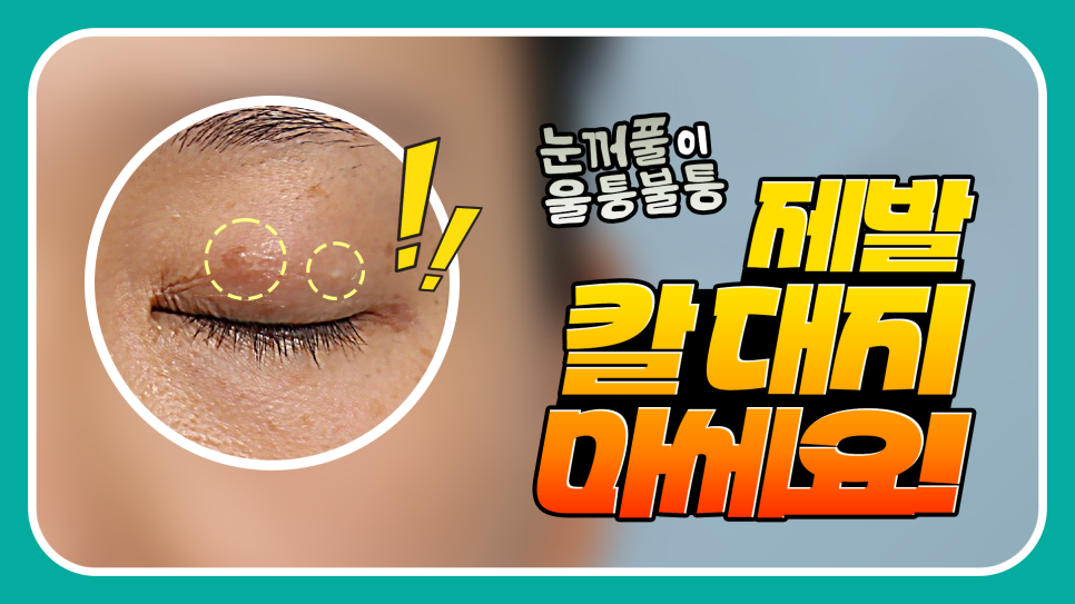 눈꺼풀에 딱딱한 여드름? 육아종 제거 [비절개] 관련 이미지 1