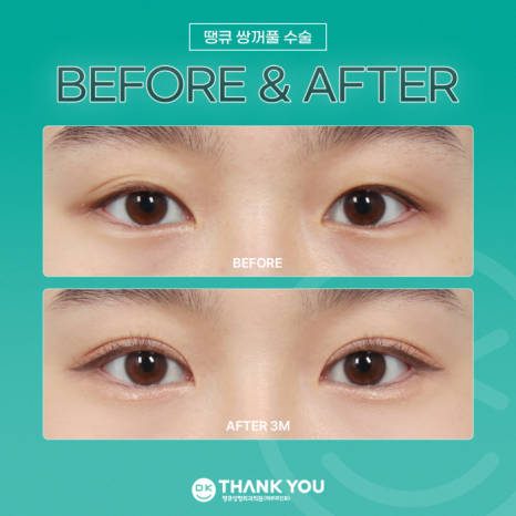 Double-Eyelid Surgery Line: Which One Suits Me Best? image 9