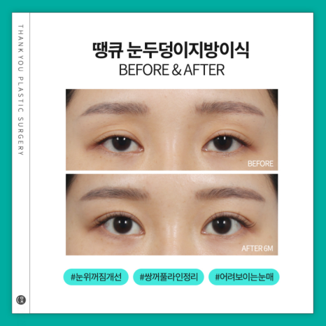 눈두덩이지방이식으로 피곤한 이미지 탈출! 생기있는 눈매 완성! 관련 이미지 10