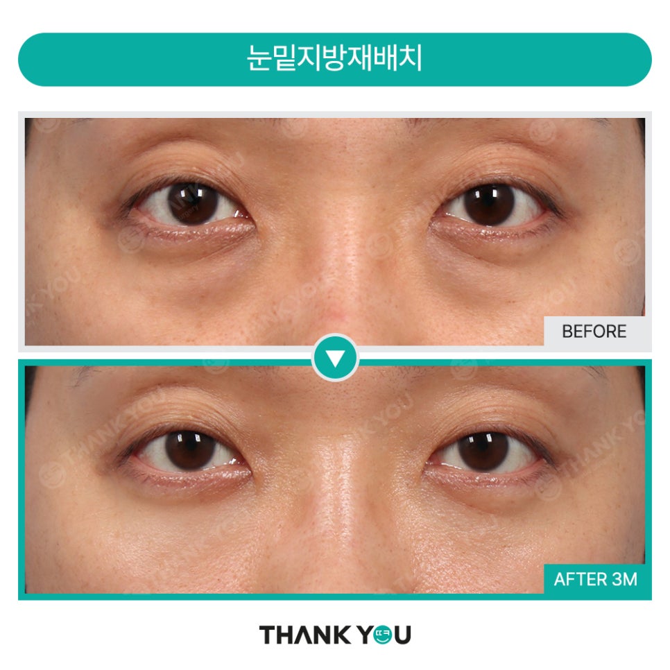 눈밑 수술, 혈류 보존이란? 관련 이미지 13