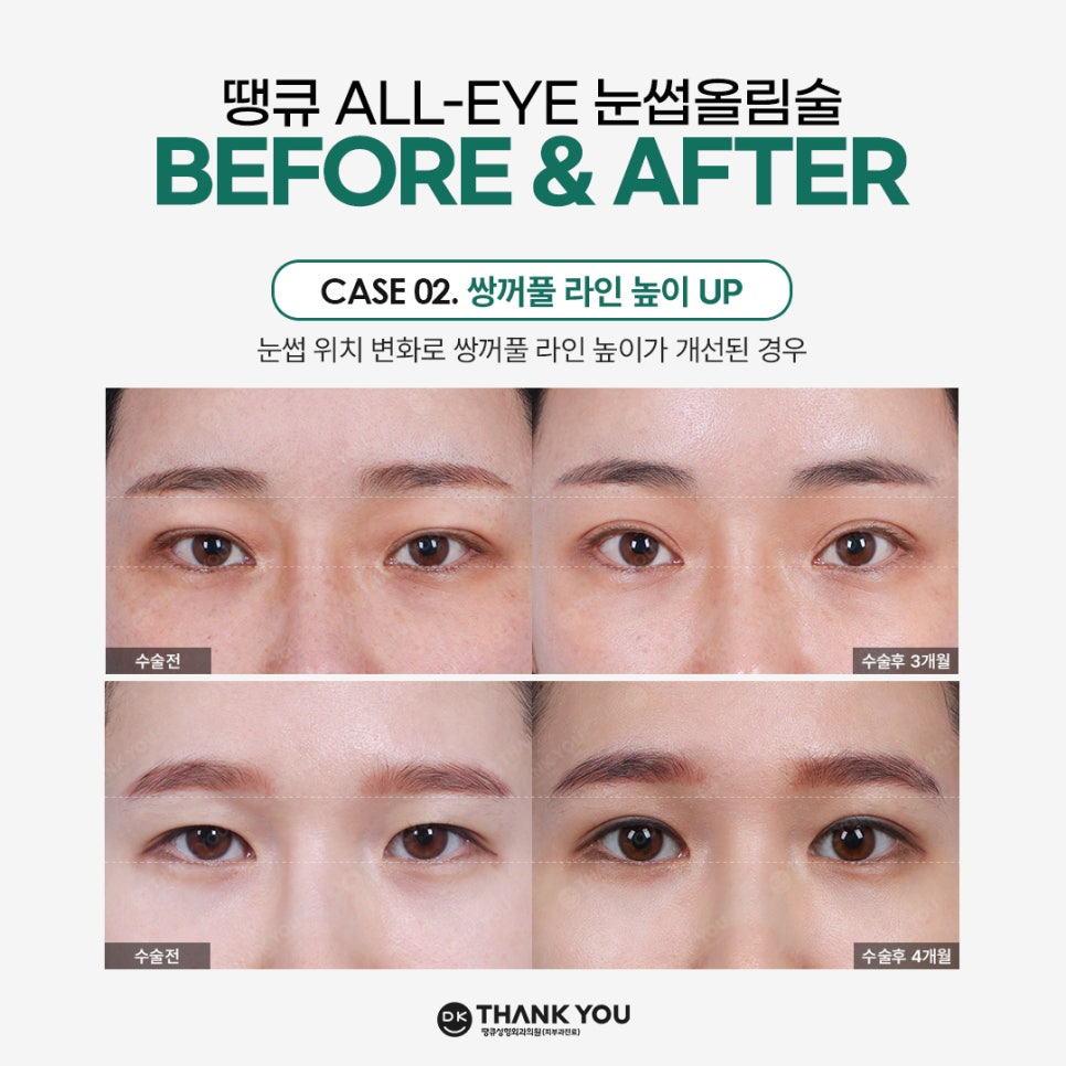 Improving Drooping, Tired-Looking Eyes in One Go with Forehead Lift Surgery! image 5