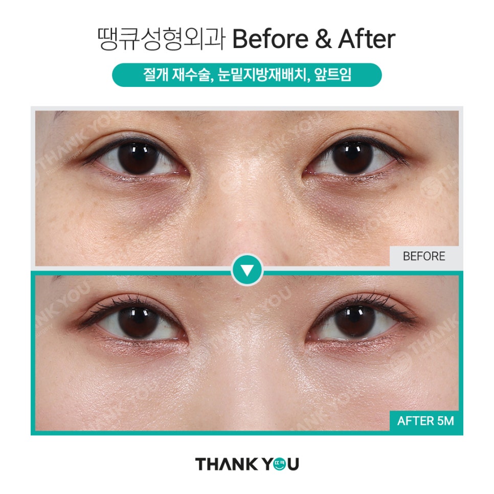 눈밑 필러 넣었는데 눈밑지방재배치 가능할까요? (이호준 칼럼) 관련 이미지 12