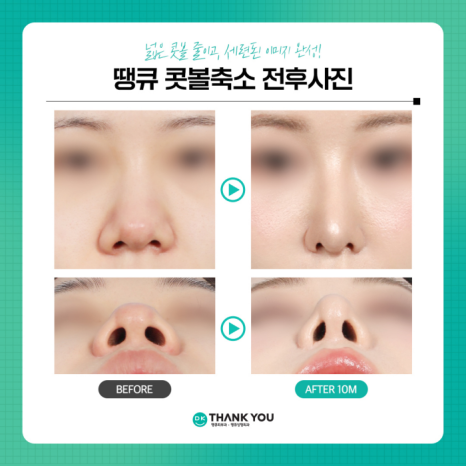콧볼축소술로 촌스러운 이미지 만드는 콧볼줄이기! 관련 이미지 10