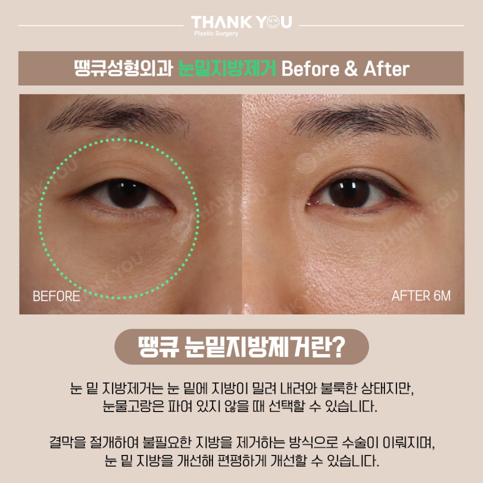 프리미엄 눈밑지방재배치(원데이)란? 땡큐 이호준 원장님 관련 이미지 7