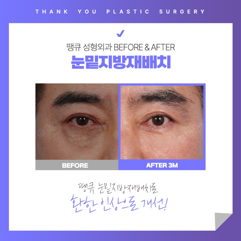 눈밑 불룩? 눈밑지방재배치 수술 후에도 재발할까? 관련 이미지 10