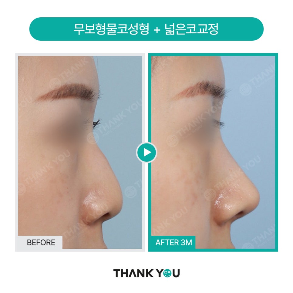 코성형 아직도 L자보형물? 실리콘 선택 기준은? 관련 이미지 13