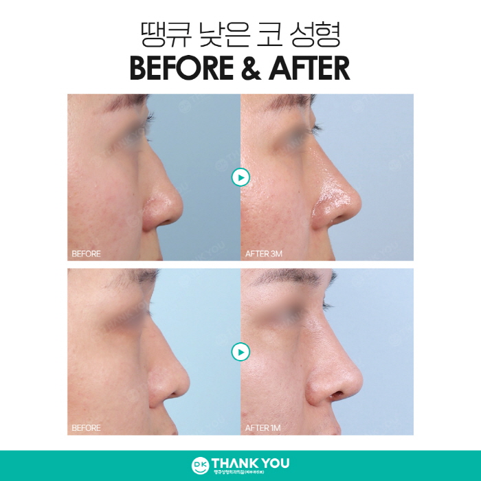낮은코성형, 완성도 높은 결과를 얻고 싶다면 주목! 관련 이미지 9