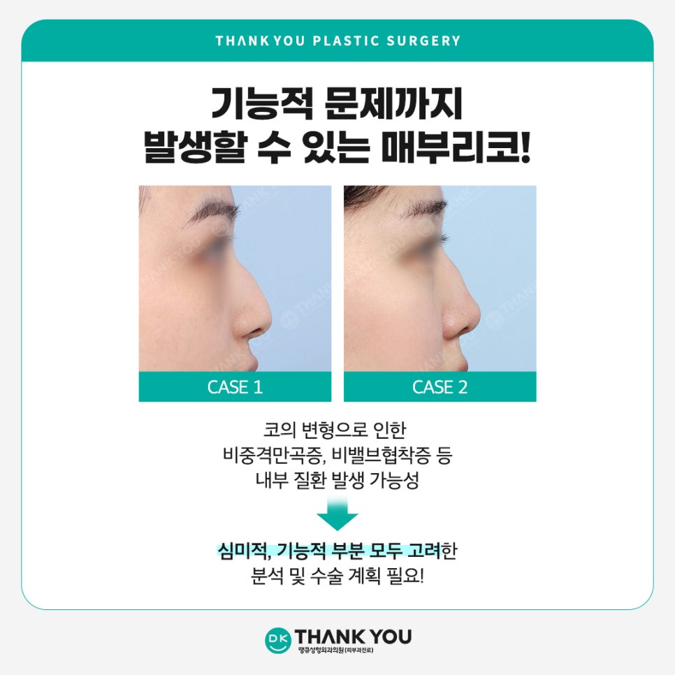 매부리코개선, 돌출 정도에 따른 맞춤 수술이 중요! 관련 이미지 4