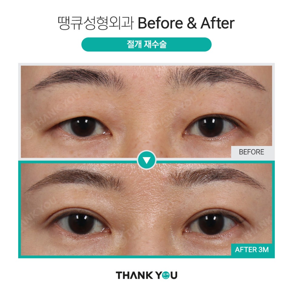 땡큐 절개쌍꺼풀 전후사진 (절개후 재수술 여부, NO?가능!) 관련 이미지 4