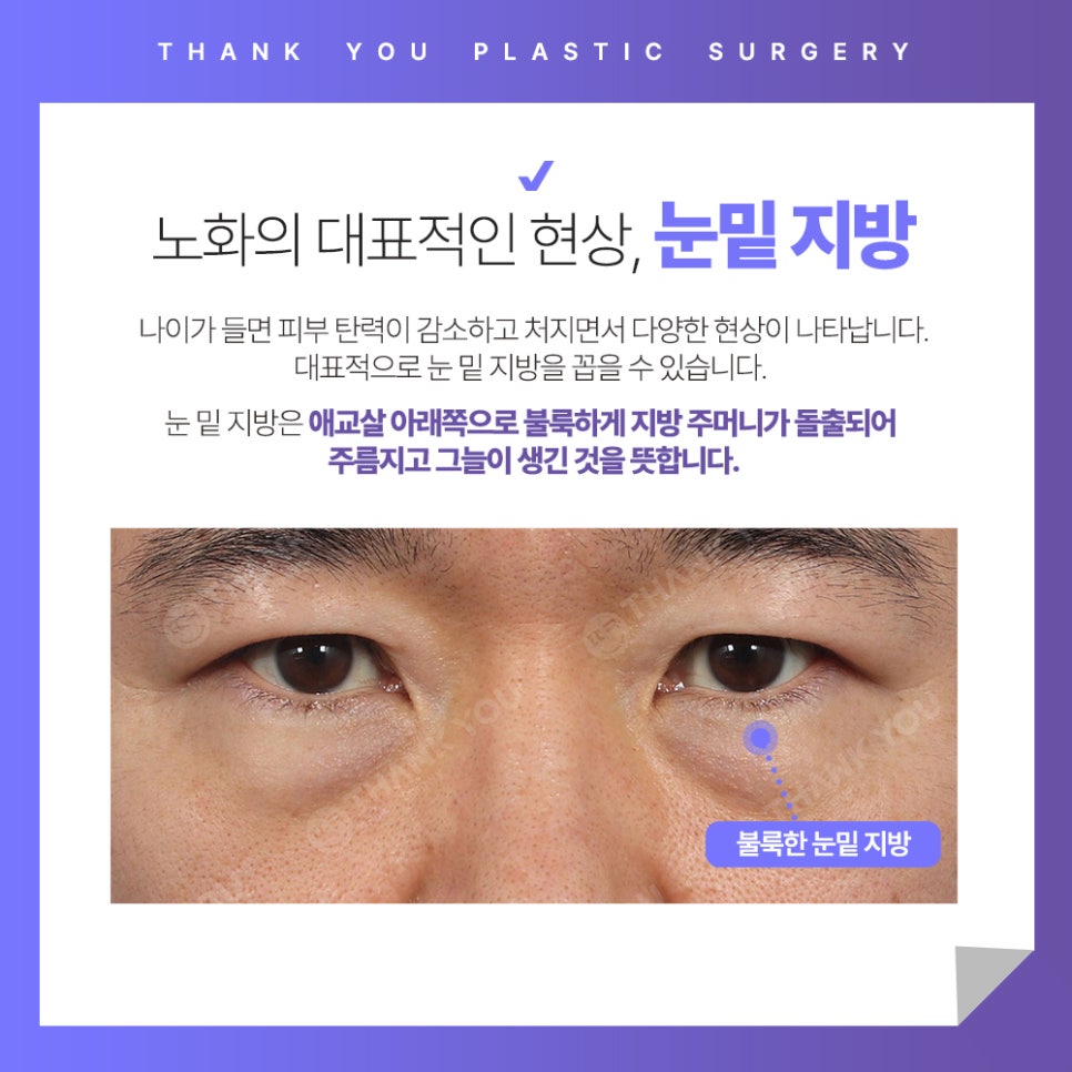 눈밑 불룩? 눈밑지방재배치 수술 후에도 재발할까? 관련 이미지 2