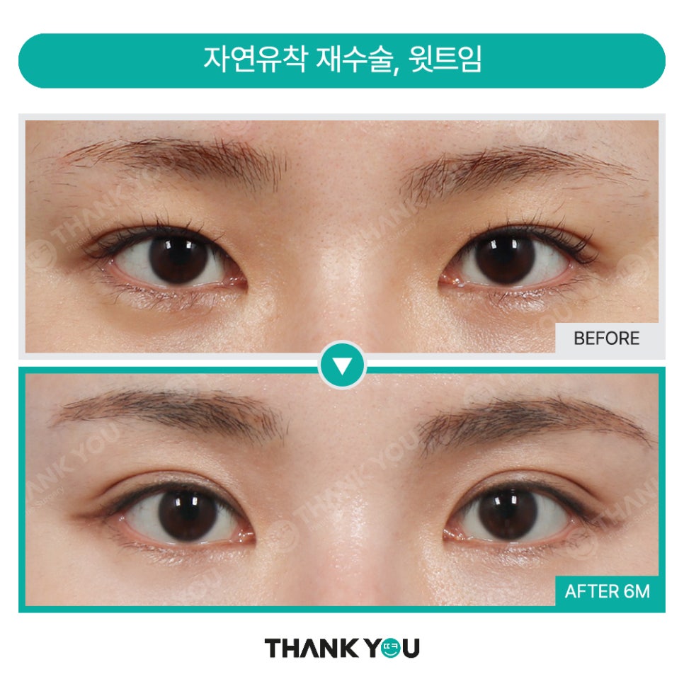 눈재수술 실패하지 않으려면? 눈 재수술유형&전후 체크 관련 이미지 13