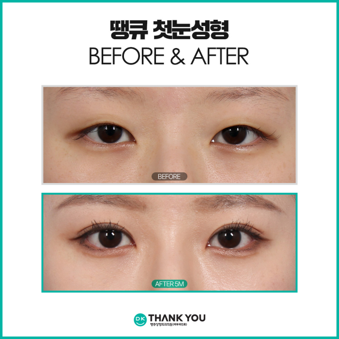 What Should You Check for First-Time Eye Surgery to Achieve Natural and Beautiful Eyes? image 7