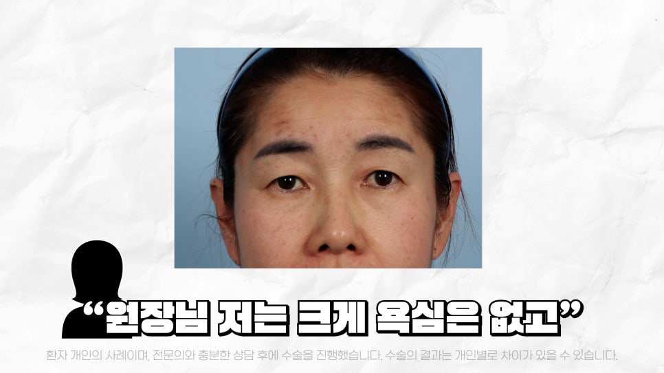 중년눈성형 전후& 이마거상+눈썹하거상+쌍수로 젊어지기 관련 이미지 8