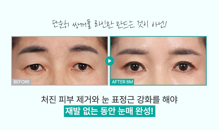 [의학칼럼]노화로 축 처진 눈꺼풀.. 동안 얼굴ㆍ눈 건강 되찾으려면? 관련 이미지 5