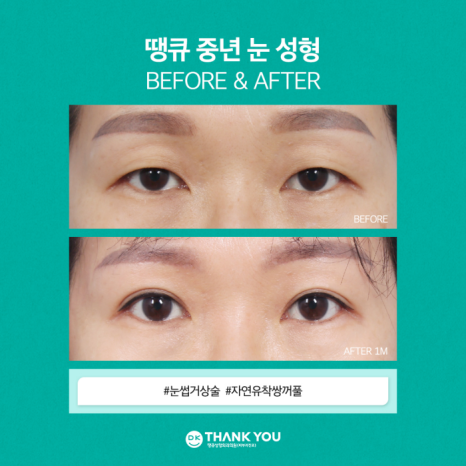 눈썹거상술 & 자연유착쌍꺼풀로 처진 눈꺼풀 효과적으로 개선! 관련 이미지 8