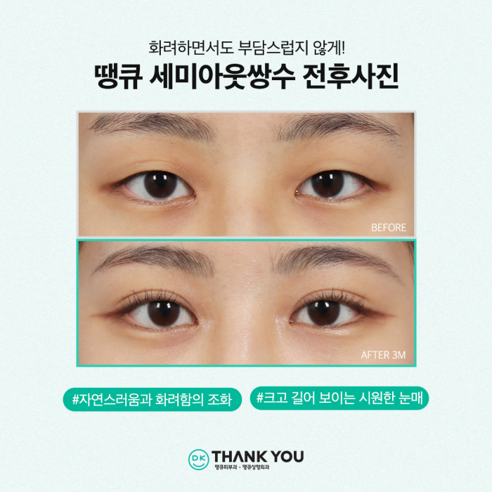 쌍수잘하는곳에서 세미아웃라인쌍꺼풀로 예쁜 눈 변신! 관련 이미지 7