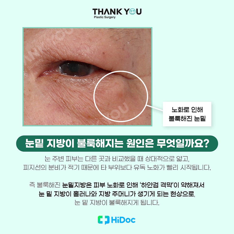 (눈밑지방불룩함)눈 지방 볼록한 이유or눈밑지 수술후 주의사항 관련 이미지 4