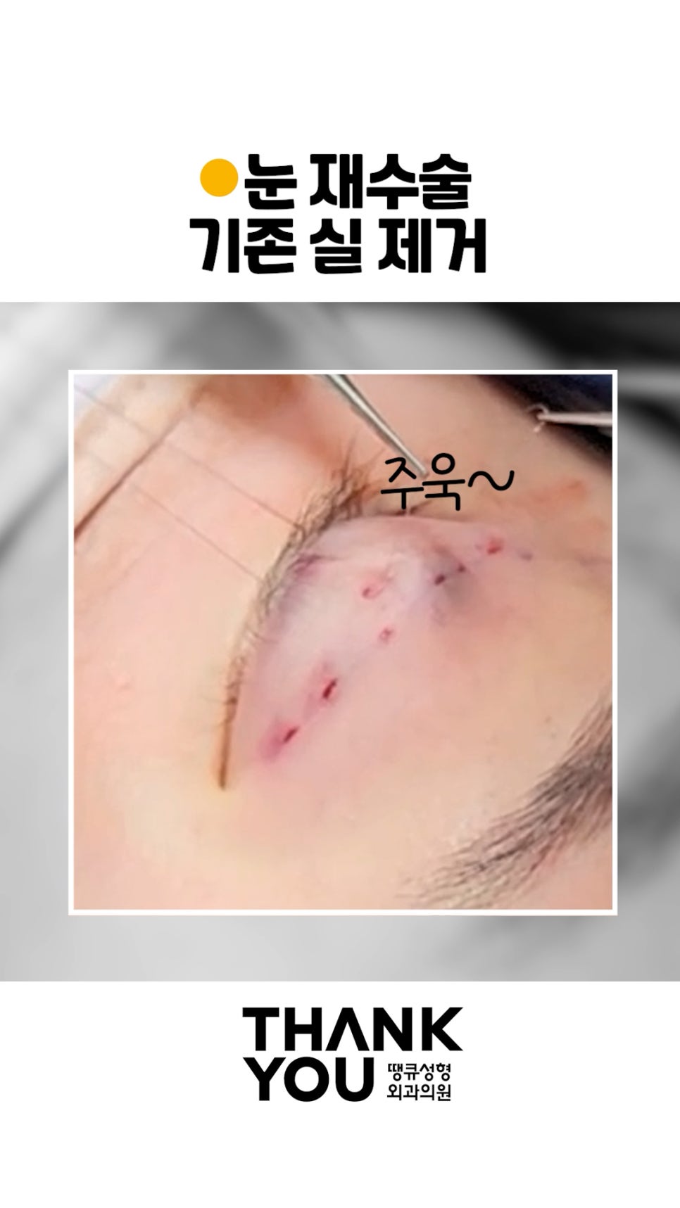 매몰 풀기, 매몰 실 제거 (15년 묵은 실)재수술 쌍꺼풀 관련 이미지 6
