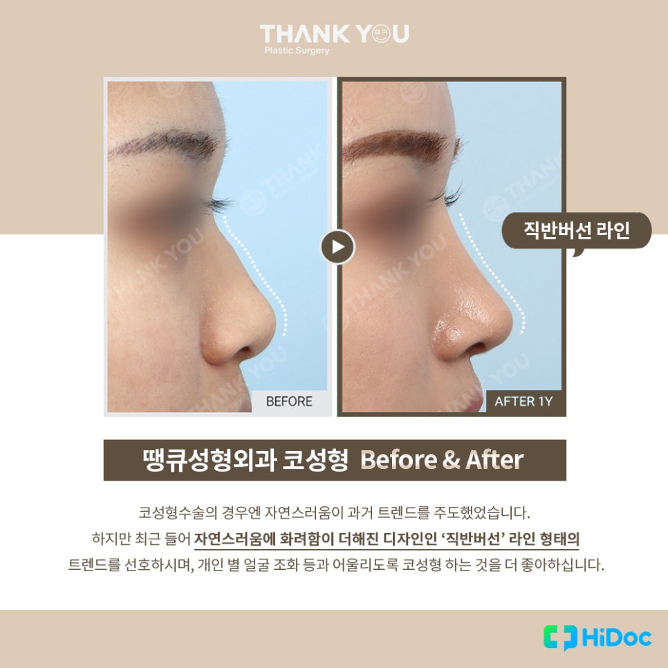 코필러 맞았는데, 코성형 가능할까?(코필러 녹이기 필수!) 관련 이미지 2