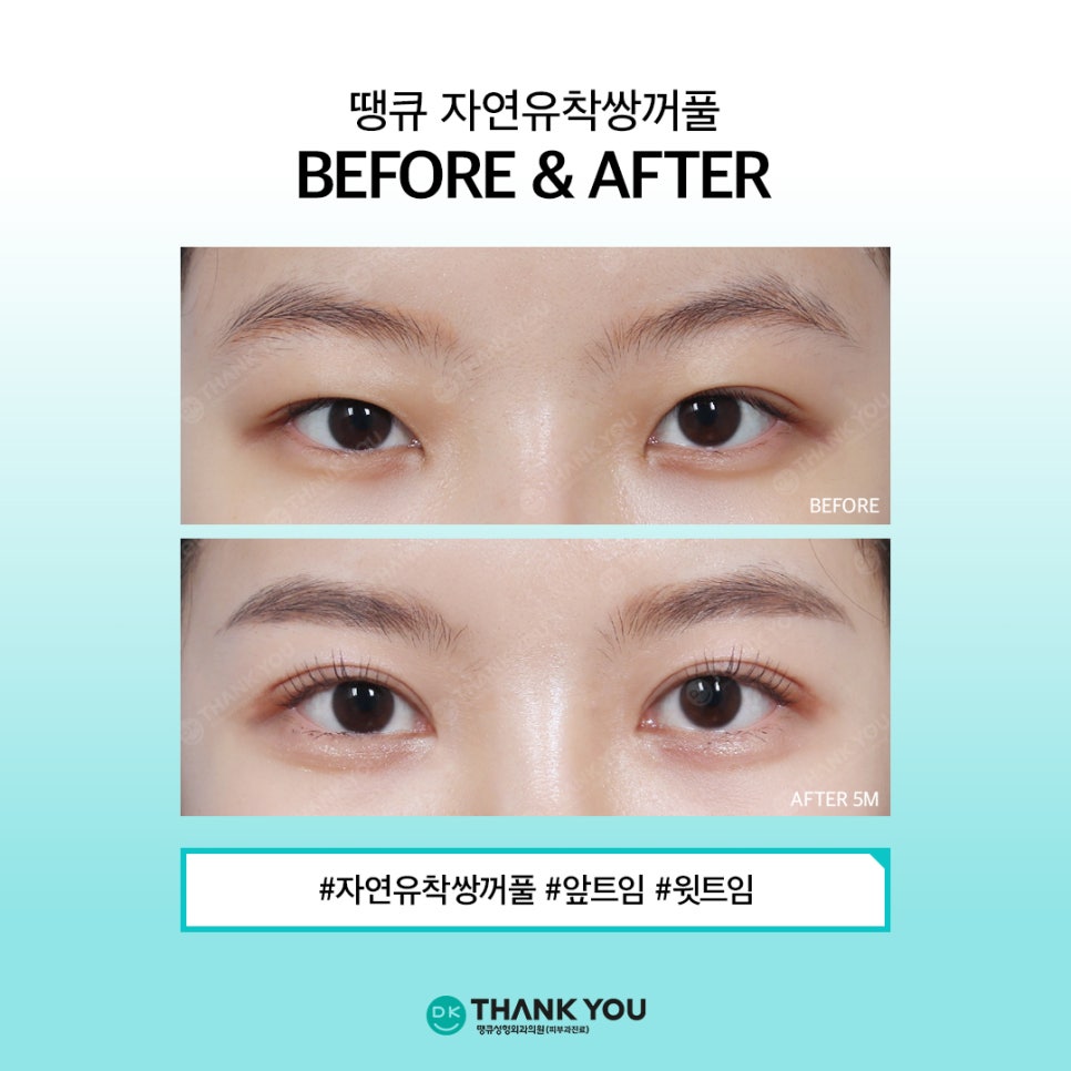 Natural Adhesion Double Eyelids: If You Want Naturalness That Lasts Longer image 8