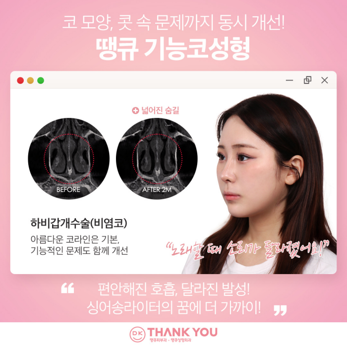 땡큐성형외과, 맥미걸 솔루션! 하비갑개수술 X 미용코, 기능&middot;미용 개선을 동시에! 관련 이미지 7