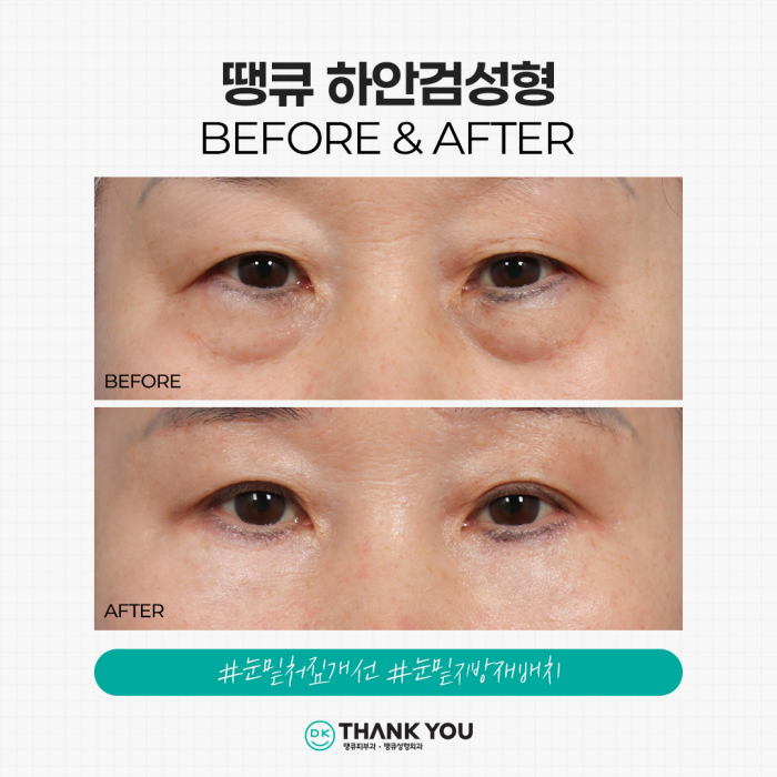 Solving Under-Eye Aging with Lower Blepharoplasty! image 7