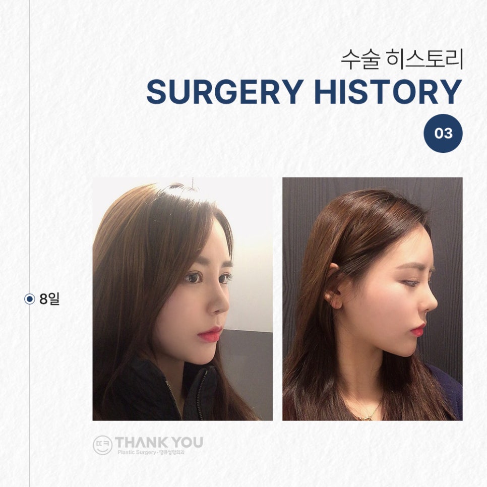 코필러 대신 여자코성형 (콧대+코끝)자연스럽게 관련 이미지 6