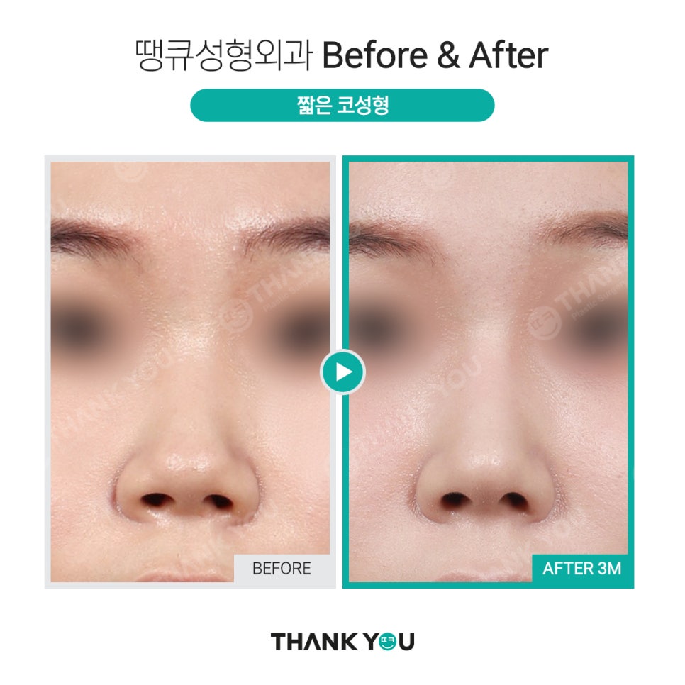 짧은코 교정의 역발상, 짧은코 성형 전후 관련 이미지 6