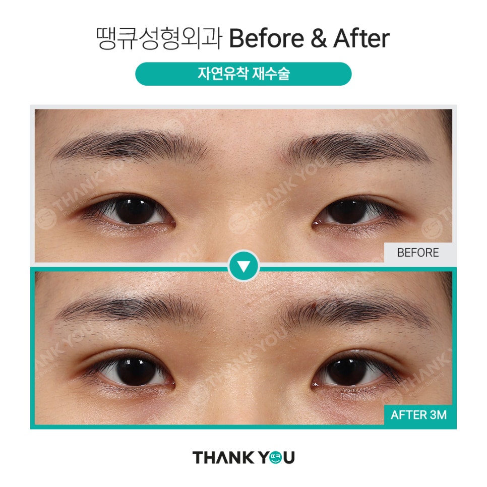 쌍수 풀기 (재수술전 실풀기+ 눈재수술 전후) 관련 이미지 16