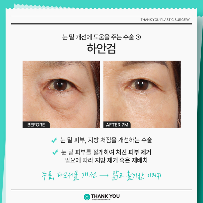 Lower Blepharoplasty and Under-Eye Fat Repositioning: What’s the Difference? image 3