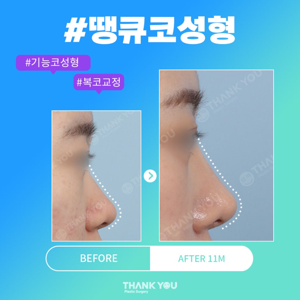 코성형 전후, 코모양 신논현역 성형외과에서 체크 관련 이미지 8