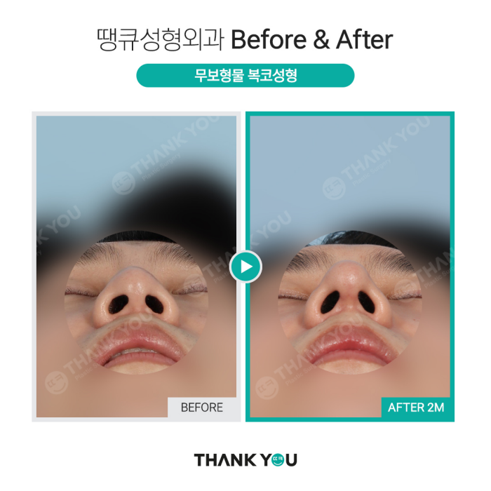 첫코성형, 자연스러운 결과를 원한다면?! >> 무보형물코성형 관련 이미지 11
