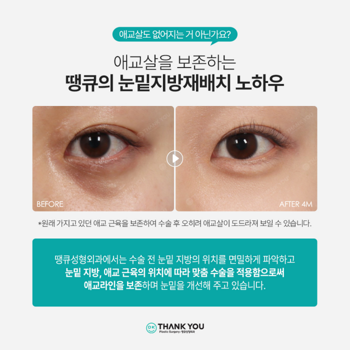 눈밑지방재배치잘하는곳은 이렇게 합니다✨✨ 관련 이미지 6