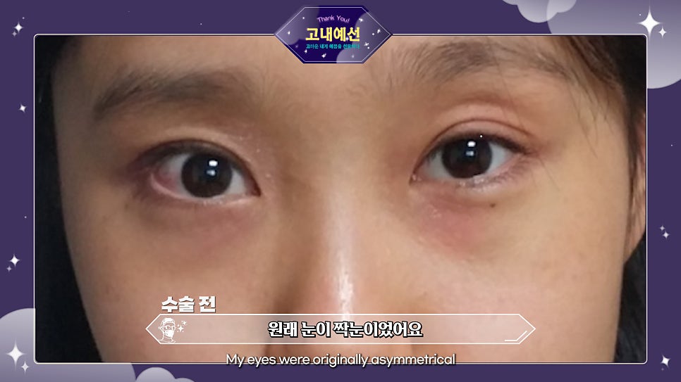 눈성형만 8번째? 땡큐에서 눈재수술 성공! 짝눈 수술전후 관련 이미지 13
