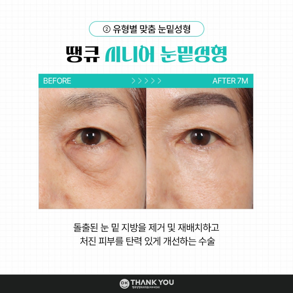 눈밑성형, 연령별로 달라지는 수술법! 무엇이 다를까? 관련 이미지 4