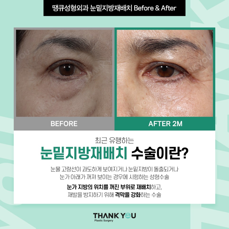 눈밑지 눈밑지방제거, 하안검 차이점은? (눈밑 비포&애프터) 관련 이미지 4