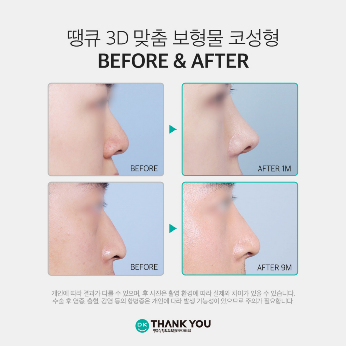 Natural-Looking Rhinoplasty with a Custom Implant That Fits Like My Original Nose! image 6