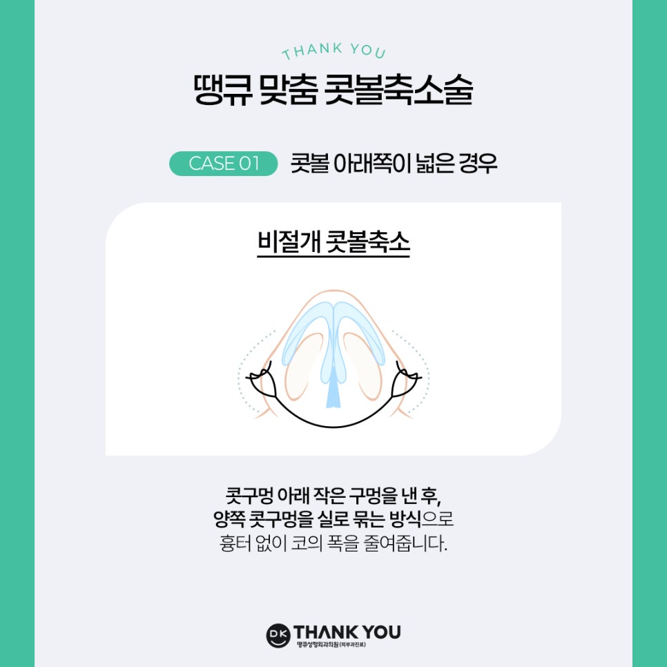 콧볼축소술, 케이스에 따른 맞춤 수술 방법은? 관련 이미지 4