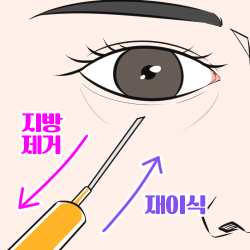 눈밑지방재배치 수술로도 볼륨이 부족한 경우엔? (ft. 앞광대 지방이식) 관련 이미지 10