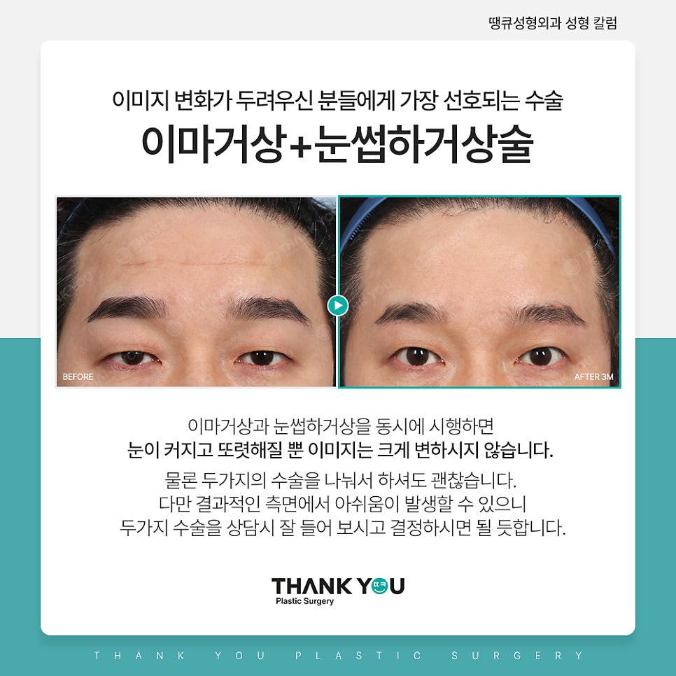쌍꺼풀수술 없이 처진 눈 해결? [중년 이마거상/ 눈썹하거상술] 관련 이미지 4
